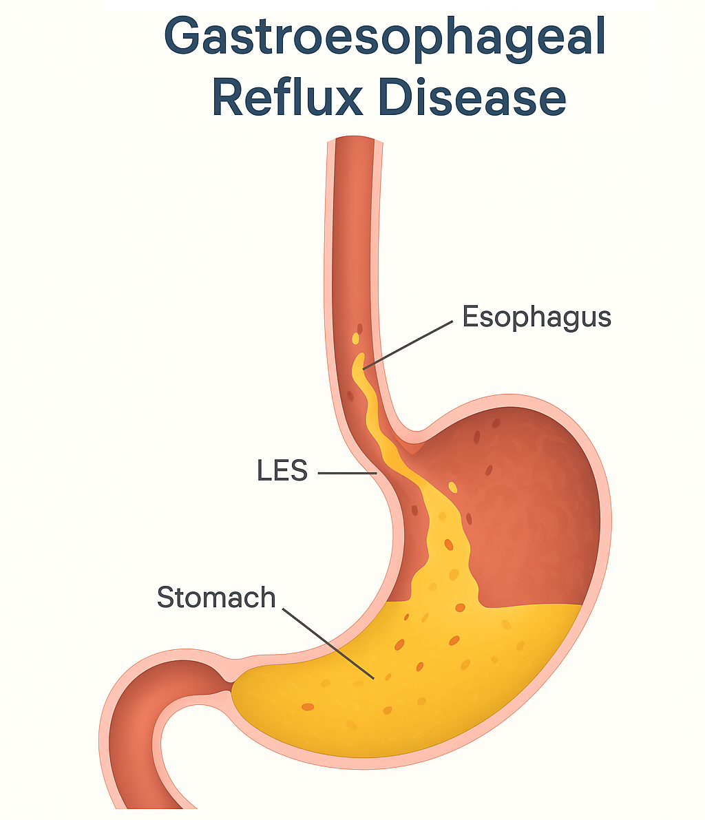 Gastroesophageal Reflux Disease Treatment in India